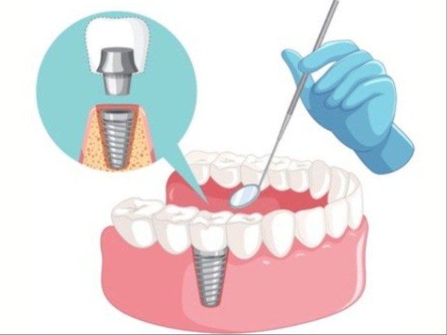 Implant Treatment